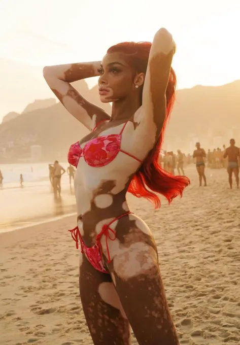 Winnie Harlow In Bikini Says “There Is No Beauty Standard”